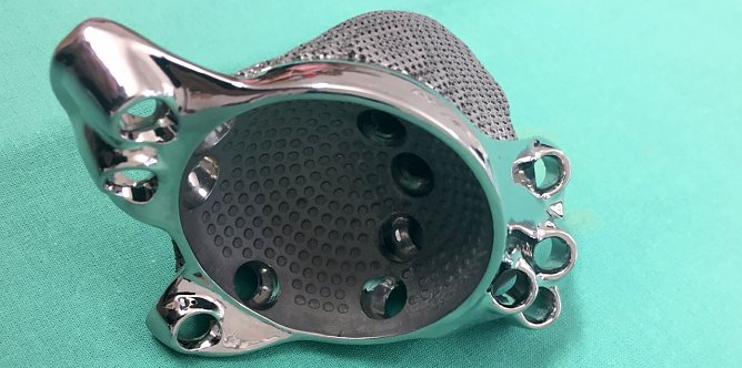 Ma&szlig;geschneidertes Implantat aus dem 3-D-Drucker (Foto: Helios Eisleben)